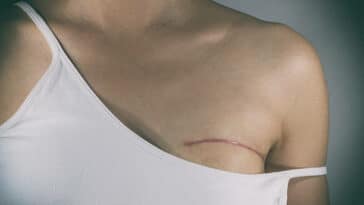 La première mastectomie assistée par robot en Israël