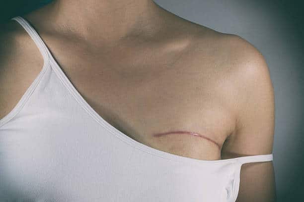 La première mastectomie assistée par robot en Israël