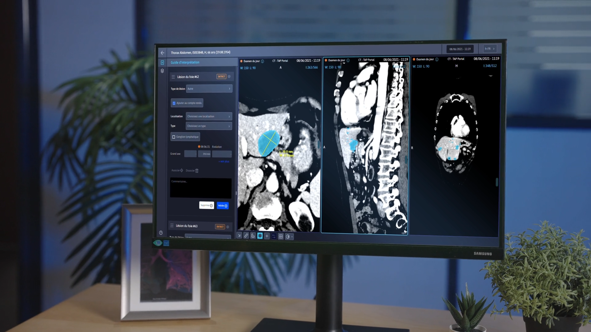 DUOnco Unity, une IA certifiée CE pour le suivi des cancers